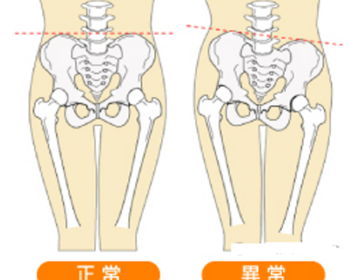 骨盤矯正